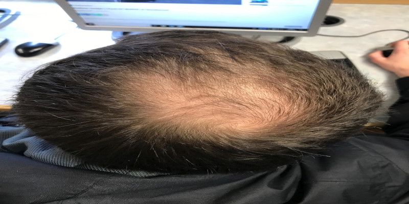 Man suffering from hair loss on the scalp at the crown of the head.
